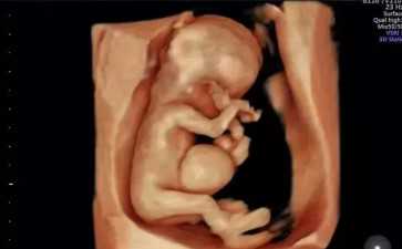 卵巢囊肿会癌变吗？治疗与代怀助孕的关联解析